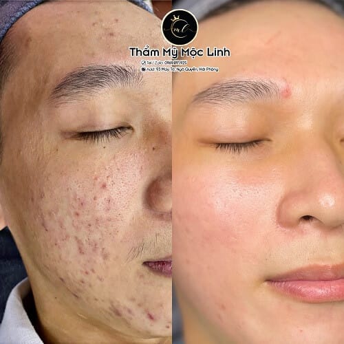 Hình ảnh thực tế tại Thẩm Mỹ Mộc Linh Hải Phòng