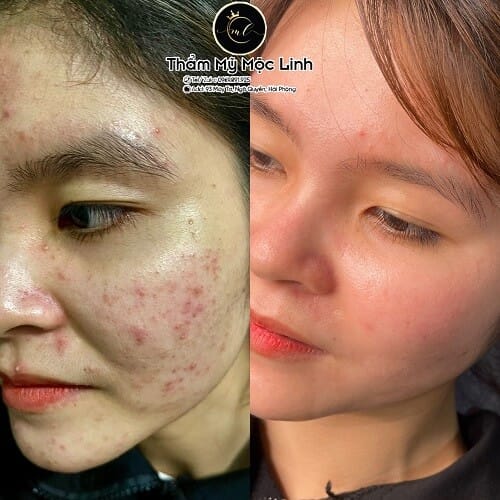 Hình ảnh thực tế tại Thẩm Mỹ Mộc Linh Hải Phòng