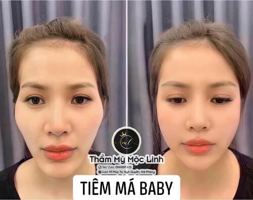 Hình ảnh thực tế tại Thẩm Mỹ Mộc Linh Hải Phòng