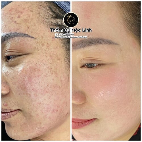 Đào tạo điều trị mụn, nám, tàn nhang, lỗ chân lông to, tại Thẩm Mỹ Mộc Linh Hải Phòng