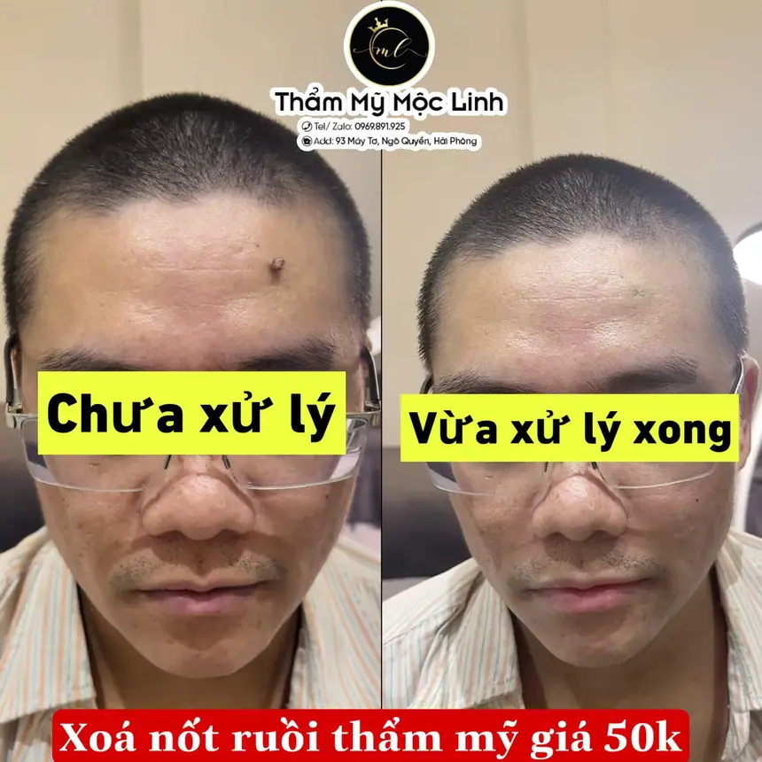 Xoá Nốt Ruồi Hiệu Quả Với Công Nghệ Laser tại Thẩm Mỹ Mộc Linh Hải Phòng - hình 2
