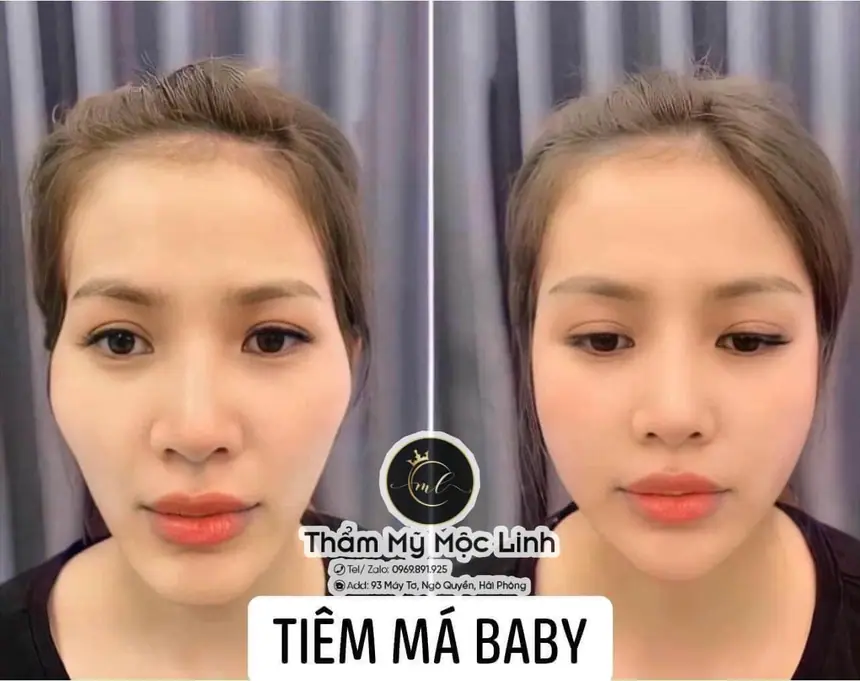 Hình ảnh thực tế tại Thẩm Mỹ Mộc Linh Hải Phòng
