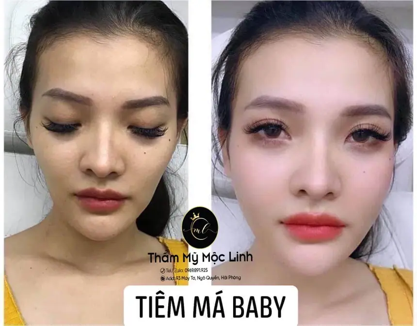 Hình ảnh thực tế tại Thẩm Mỹ Mộc Linh Hải Phòng