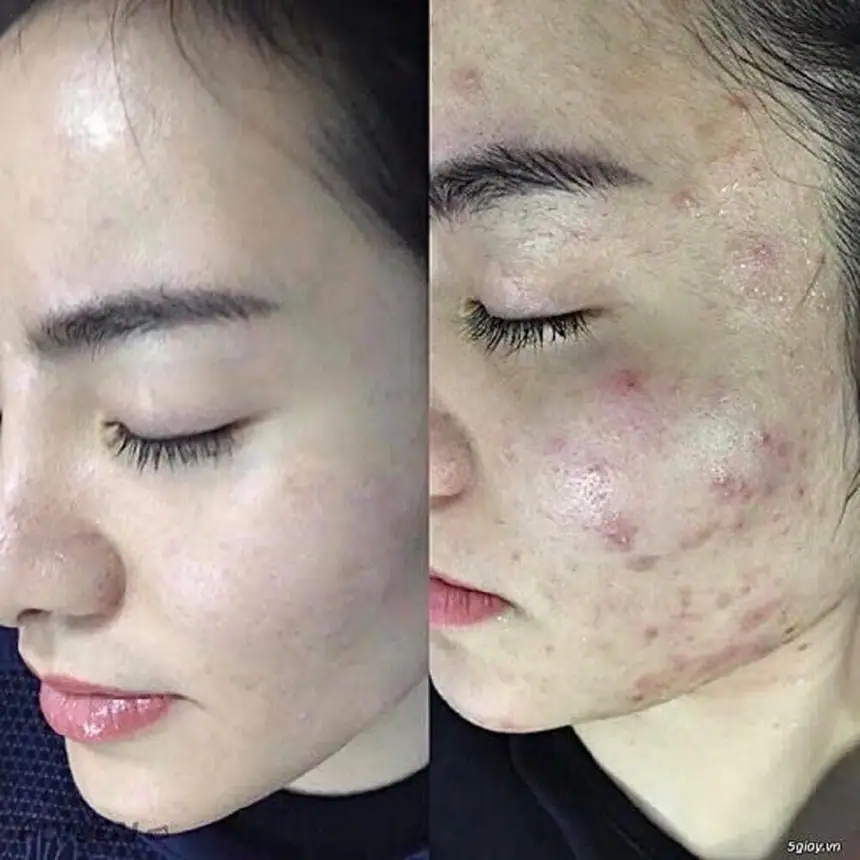 Cơ sở đào tạo điều trị mụn chuẩn y khoa uy tín tại Hải tại Thẩm Mỹ Mộc Linh Hải Phòng