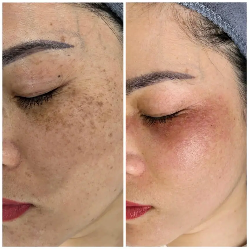 Điều trị tàn nhang tại Thẩm Mỹ Mộc Linh Hải Phòng