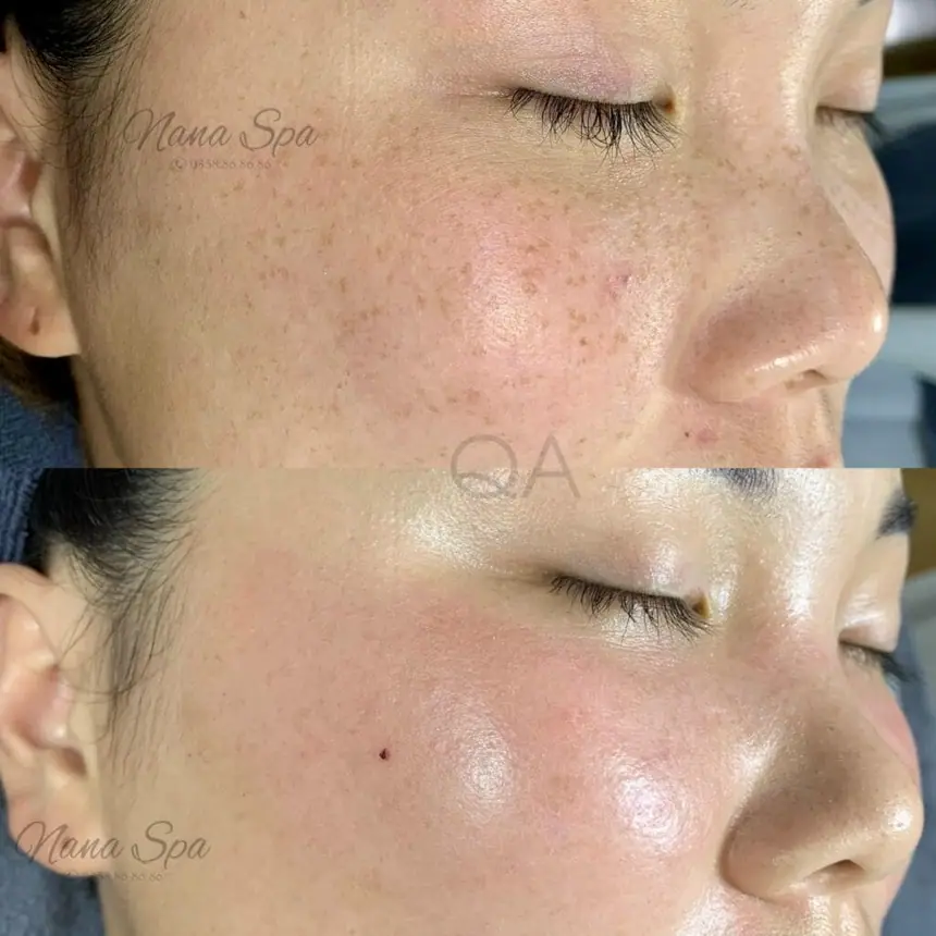 Trị nám/tàn nhang uy tín tại Hải Phòng tại Thẩm Mỹ Mộc Linh - hình 87