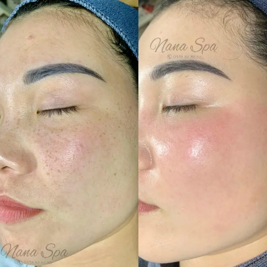 Trị nám/tàn nhang uy tín tại Hải Phòng tại Thẩm Mỹ Mộc Linh - hình 88