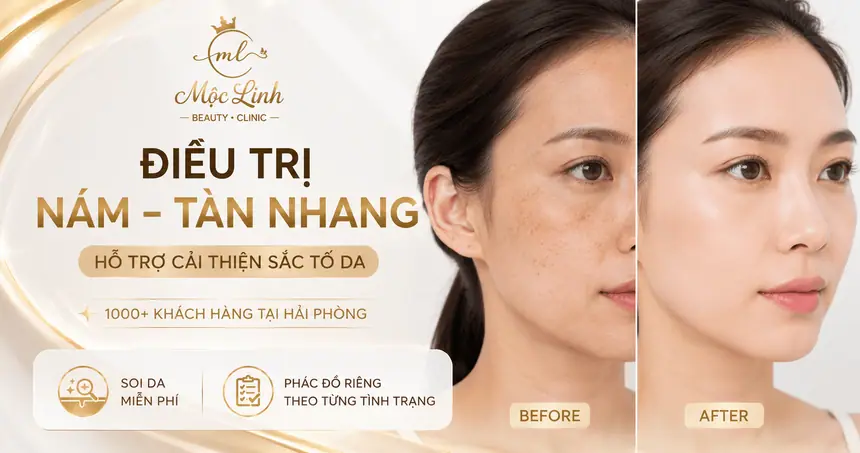 Điều Trị Nám