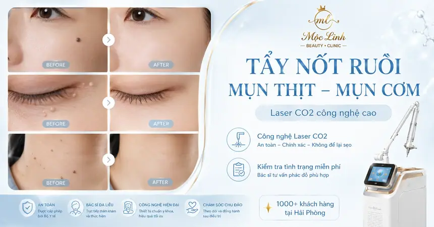 Tẩy Mụn Ruồi, Mụn Thịt