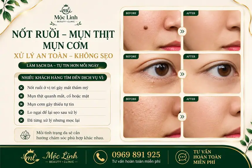 Tẩy nốt ruồi, mụn cơm, mụn thịt tại Thẩm Mỹ Mộc Linh Hải Phòng - hình 2