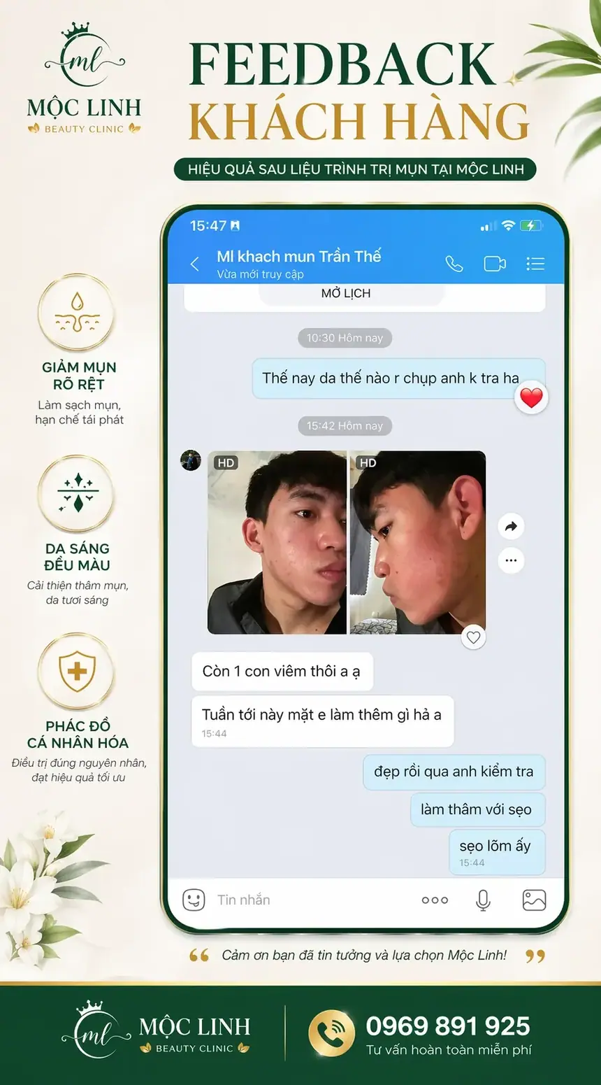 Công nghệ điều trị mụn hiện đại tại Hải Phòng