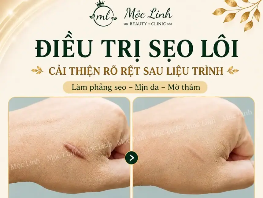 Điều trị các loại sẹo uy tín Hải Phòng tại Thẩm Mỹ Mộc Linh - hình 23