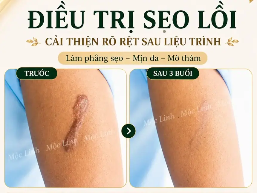 Điều trị các loại sẹo uy tín Hải Phòng tại Thẩm Mỹ Mộc Linh - hình 22