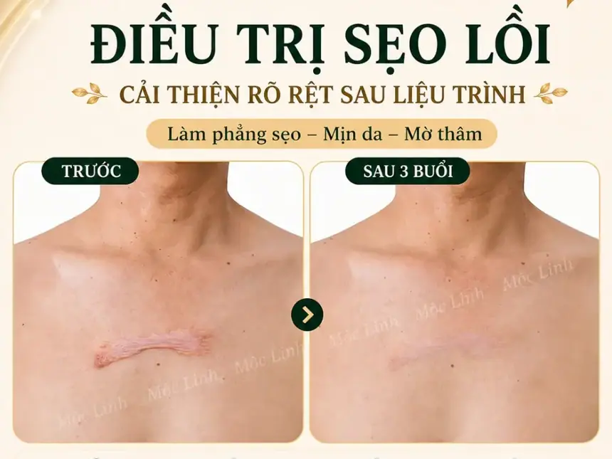 Điều trị các loại sẹo uy tín Hải Phòng tại Thẩm Mỹ Mộc Linh - hình 21
