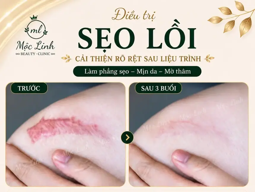 Điều trị các loại sẹo uy tín Hải Phòng tại Thẩm Mỹ Mộc Linh - hình 20