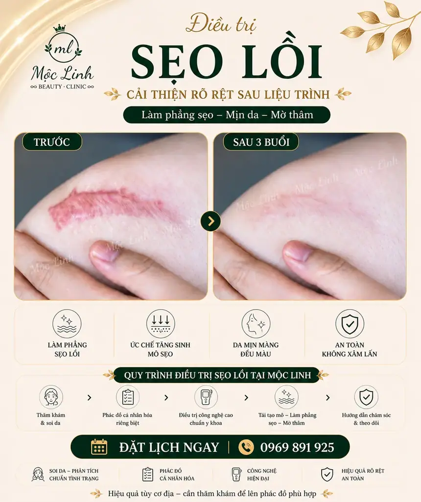 Kết quả điều trị sẹo lõm tại Thẩm Mỹ Mộc Linh Hải Phòng