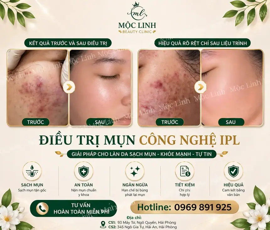 Liệu trình trị mụn chuẩn y khoa Hải Phòng