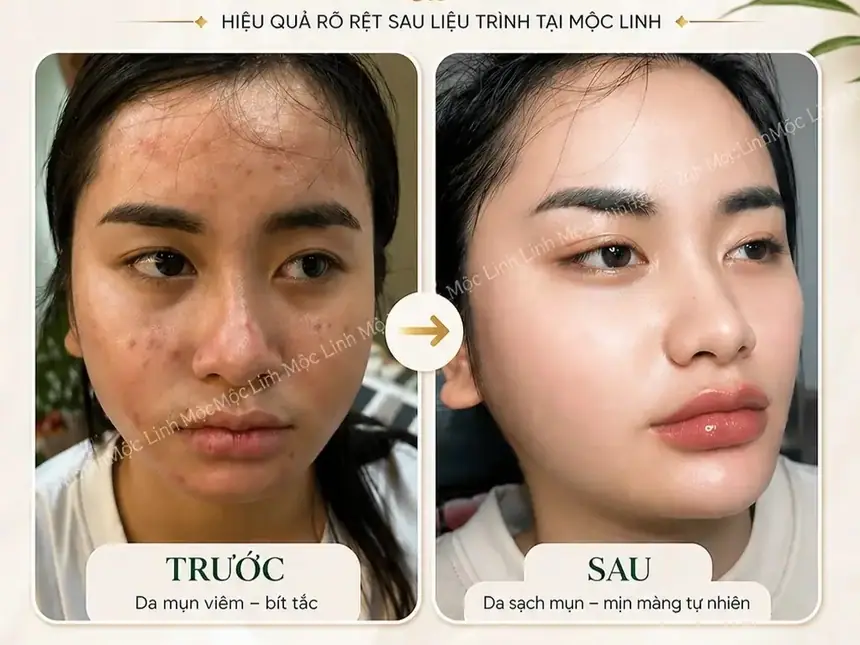 Hiệu quả điều trị mụn bọc tại Thẩm Mỹ Mộc Linh Hải Phòng