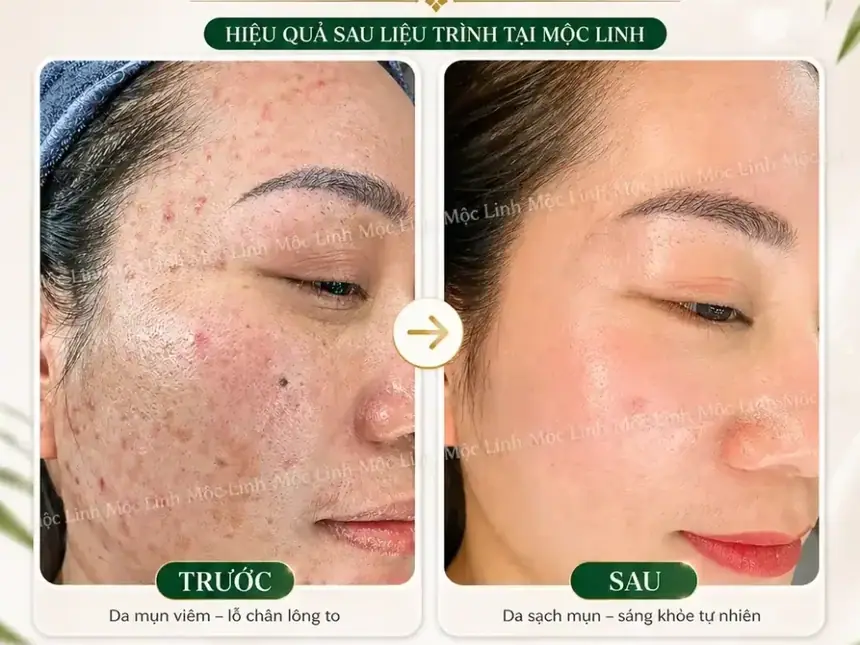 Làn da sạch mụn sau liệu trình trị mụn tại Mộc Linh Hải Phòng