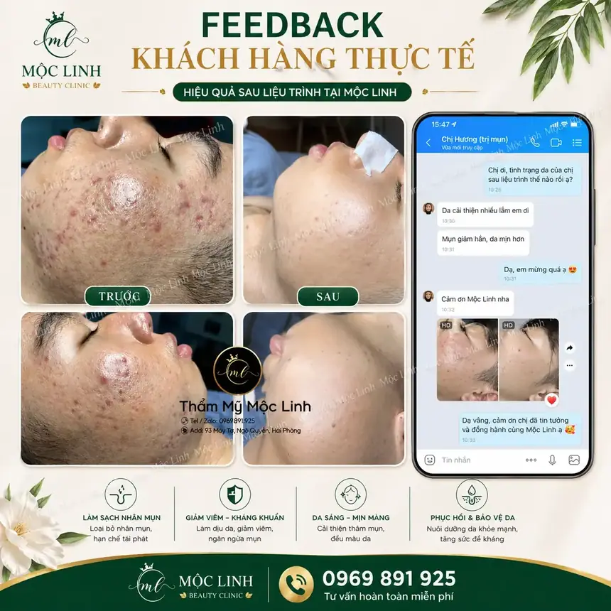 Bảng giá trị mụn tại Hải Phòng