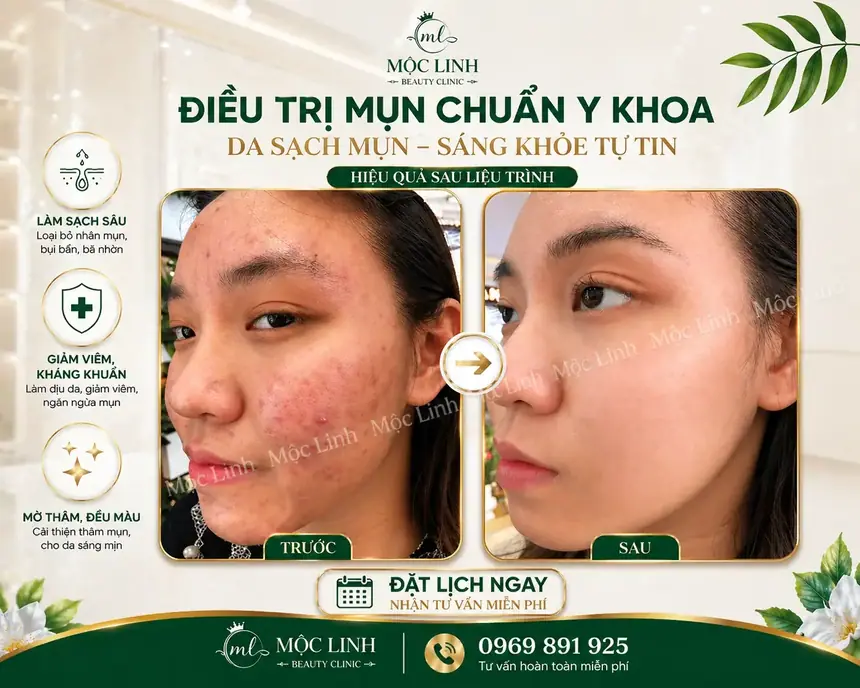 Điều trị mụn uy tín tại Hải Phòng