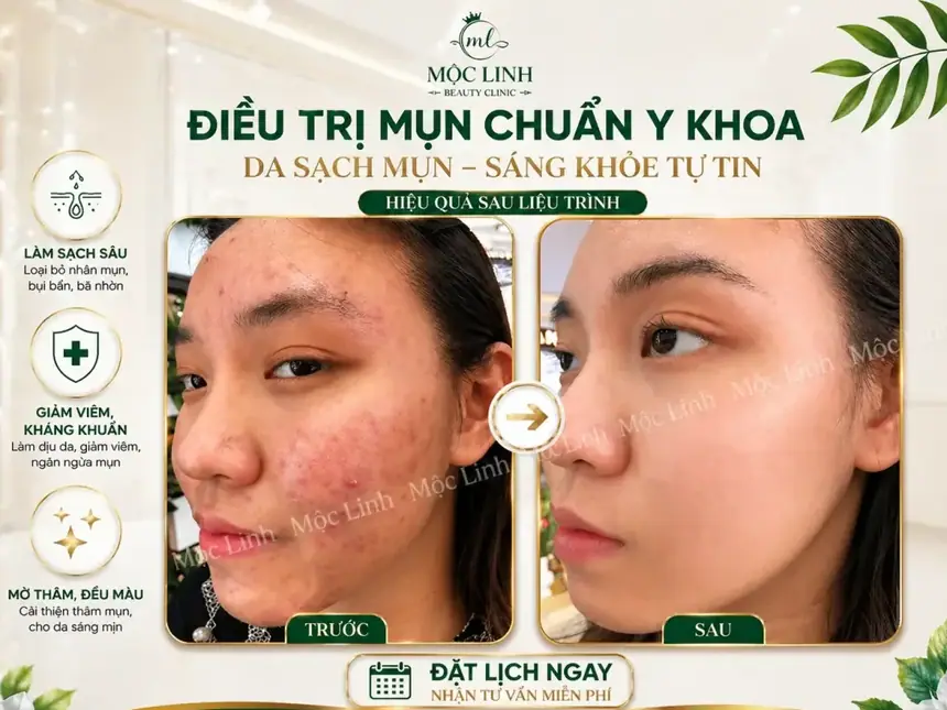 Kết quả trị mụn viêm cải thiện rõ tại Thẩm Mỹ Mộc Linh