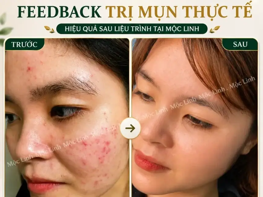 Phản hồi khách hàng sau điều trị mụn tại Mộc Linh Hải Phòng