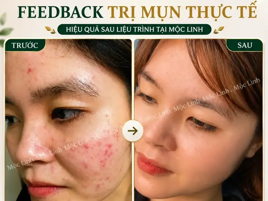 Da sau khi lấy nhân mụn và chăm sóc phục hồi tại Mộc Linh