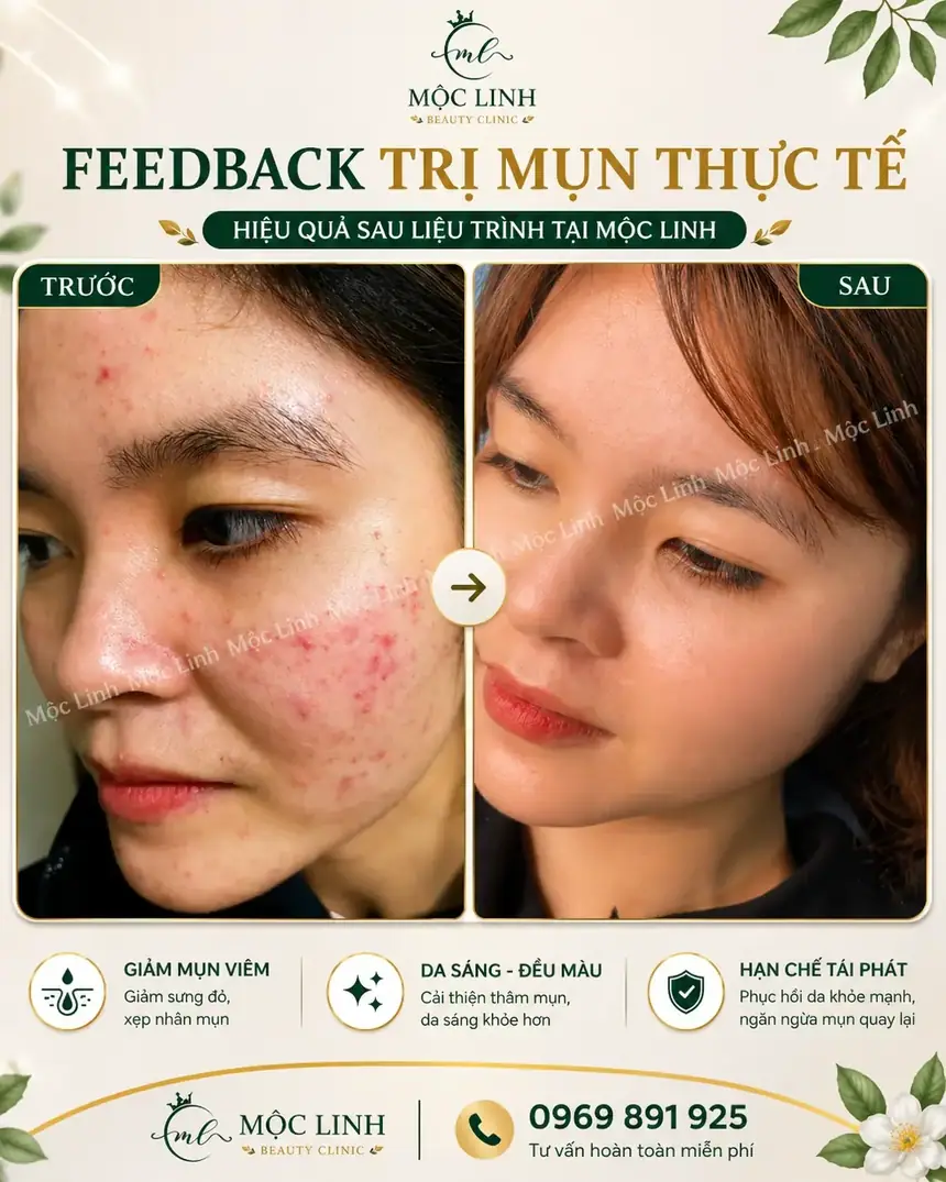 Kết quả trị mụn tại Thẩm Mỹ Mộc Linh