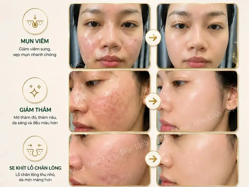 Cải thiện da dầu mụn sau điều trị tại Mộc Linh Hải Phòng