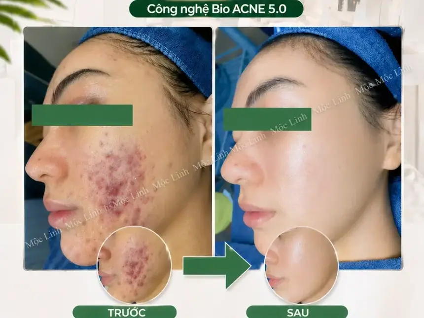 Trước và sau điều trị mụn ẩn tại Thẩm Mỹ Mộc Linh