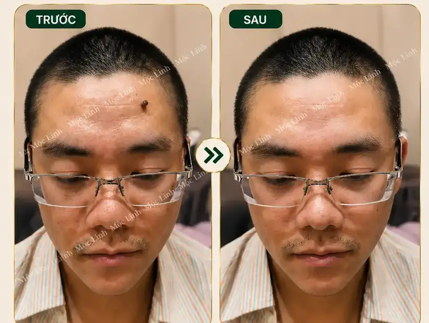 Tẩy nốt ruồi, mụn cơm, mụn thịt tại Thẩm Mỹ Mộc Linh Hải Phòng - hình 6