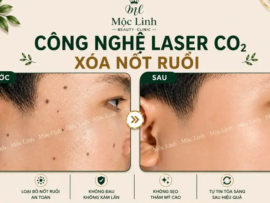 Tẩy nốt ruồi, mụn cơm, mụn thịt tại Thẩm Mỹ Mộc Linh Hải Phòng - hình 23