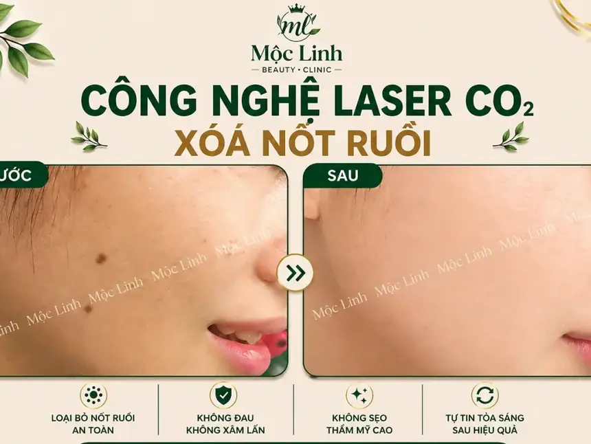 Tẩy nốt ruồi, mụn cơm, mụn thịt tại Thẩm Mỹ Mộc Linh Hải Phòng - hình 5