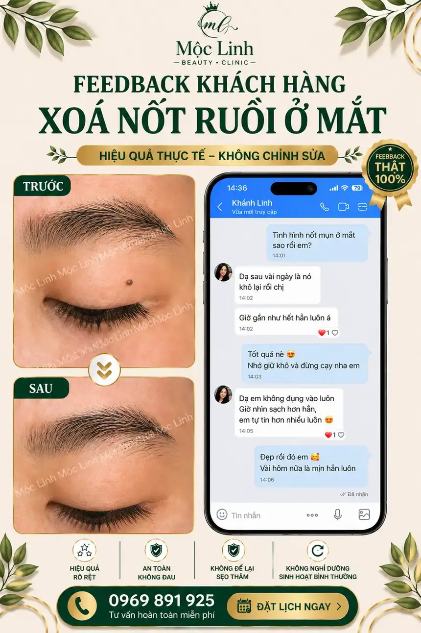 Tẩy nốt ruồi, mụn cơm, mụn thịt tại Thẩm Mỹ Mộc Linh Hải Phòng - hình 9