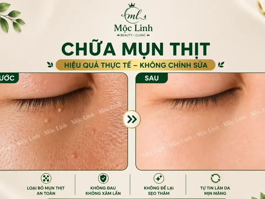 Tẩy nốt ruồi, mụn cơm, mụn thịt tại Thẩm Mỹ Mộc Linh Hải Phòng - hình 4