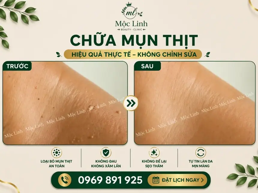 Tẩy nốt ruồi, mụn cơm, mụn thịt tại Thẩm Mỹ Mộc Linh Hải Phòng - hình 18