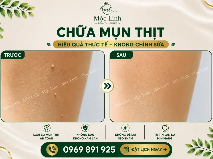 Tẩy nốt ruồi, mụn cơm, mụn thịt tại Thẩm Mỹ Mộc Linh Hải Phòng - hình 17