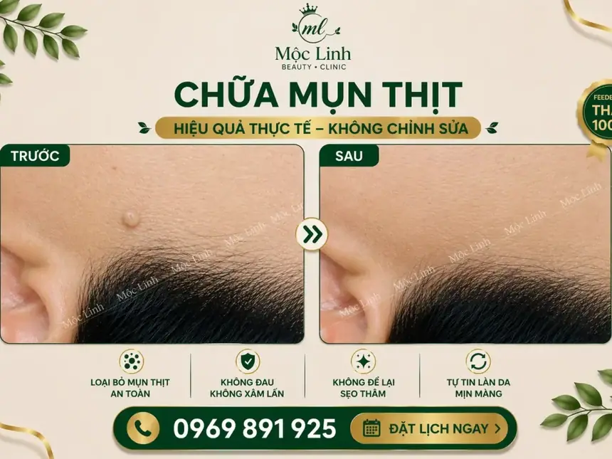 Tẩy nốt ruồi, mụn cơm, mụn thịt tại Thẩm Mỹ Mộc Linh Hải Phòng - hình 16