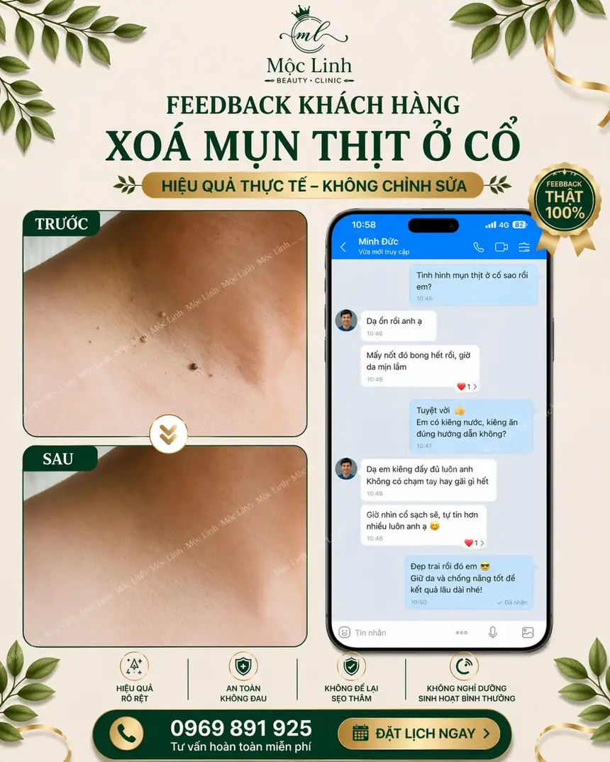 Tẩy nốt ruồi, mụn cơm, mụn thịt tại Thẩm Mỹ Mộc Linh Hải Phòng - hình 11