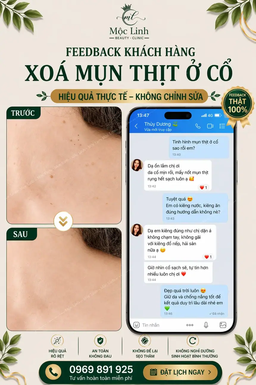 Tẩy nốt ruồi, mụn cơm, mụn thịt tại Thẩm Mỹ Mộc Linh Hải Phòng - hình 10