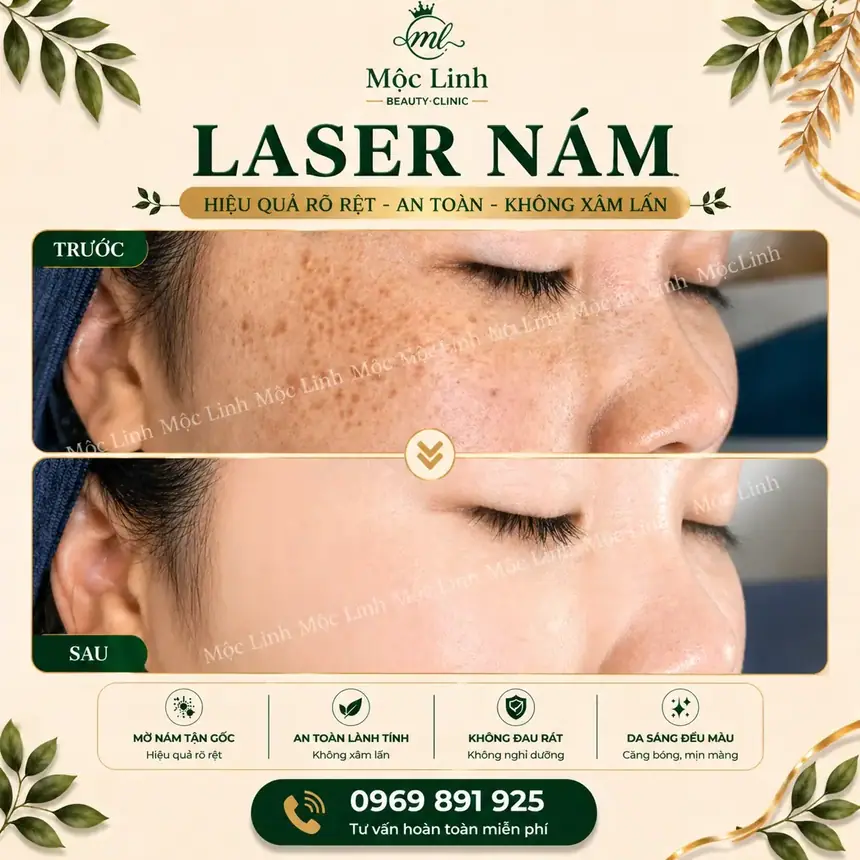 Trị nám tàn nhang uy tín tại Hải Phòng