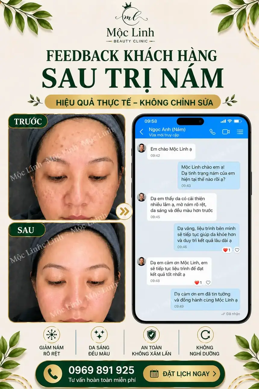 Kết quả điều trị nám tại Thẩm Mỹ Mộc Linh