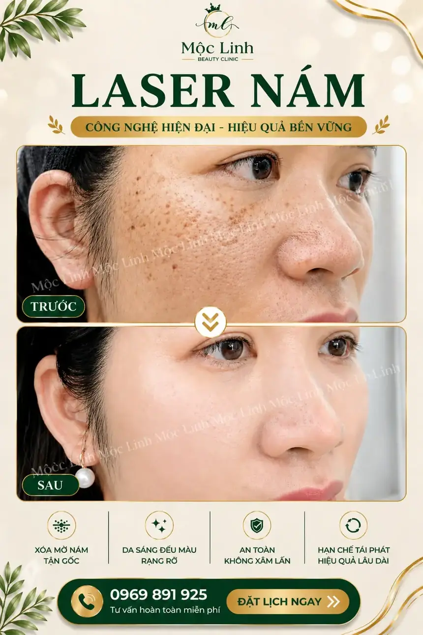 Công nghệ trị nám hiện đại tại Hải Phòng