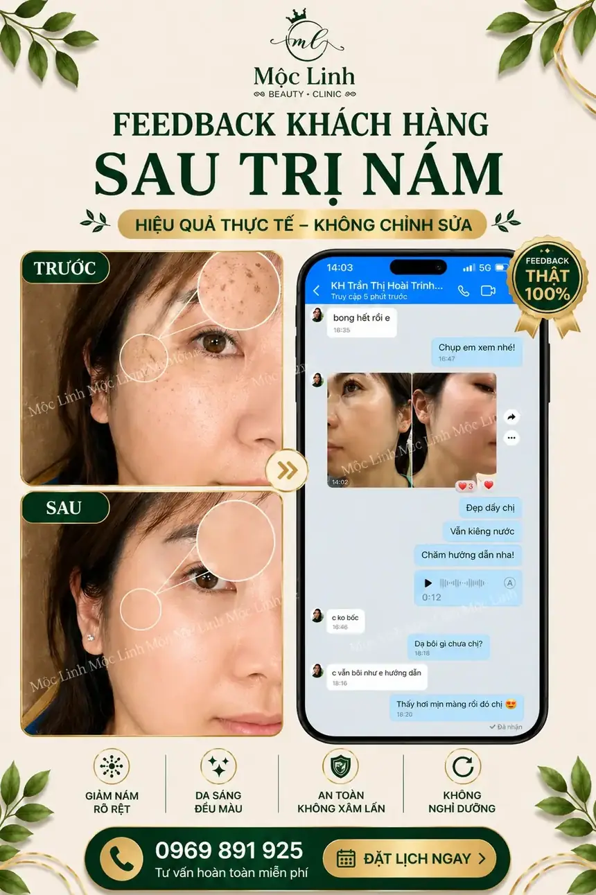 Bảng giá điều trị nám tại Hải Phòng