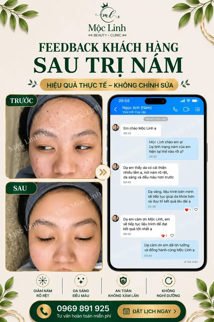 Chăm sóc da sau điều trị nám tại Mộc Linh
