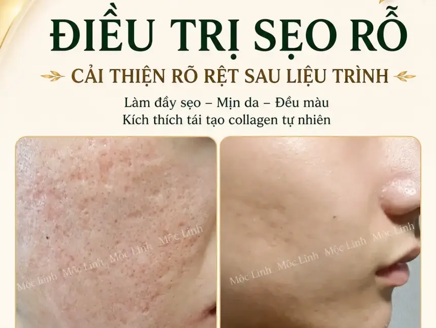 Điều trị các loại sẹo uy tín Hải Phòng tại Thẩm Mỹ Mộc Linh - hình 18