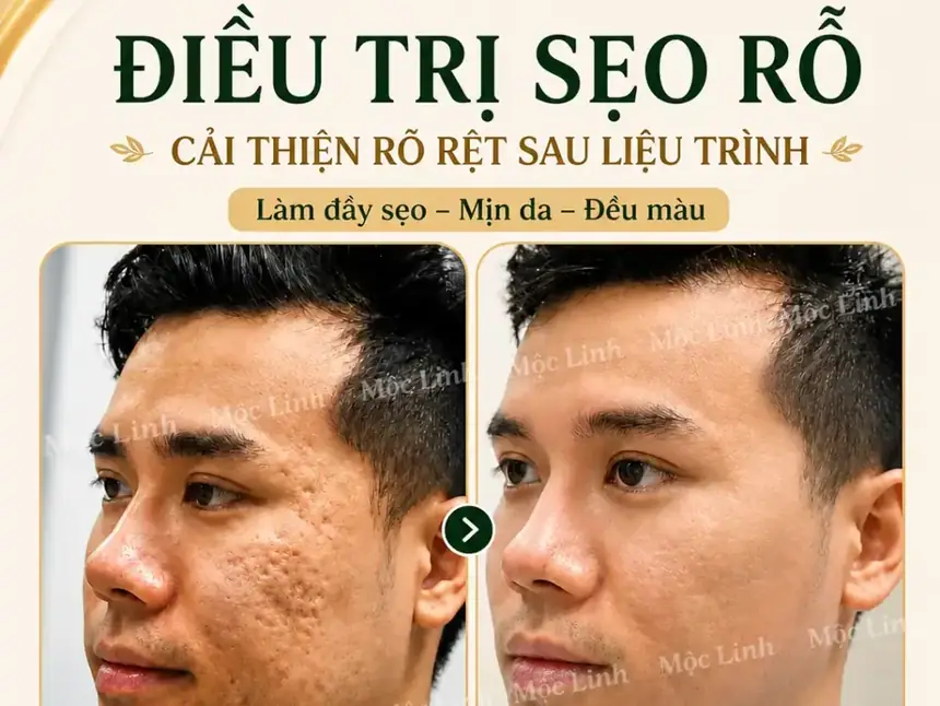 Điều trị các loại sẹo uy tín Hải Phòng tại Thẩm Mỹ Mộc Linh - hình 17