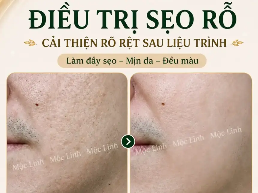 Điều trị các loại sẹo uy tín Hải Phòng tại Thẩm Mỹ Mộc Linh - hình 16