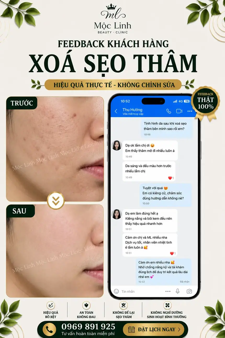 Điều trị sẹo chuyên sâu tại Thẩm Mỹ Mộc Linh Hải Phòng